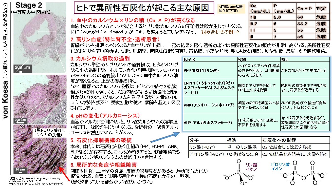 ヒトで異所性石灰化が起こる主な原因